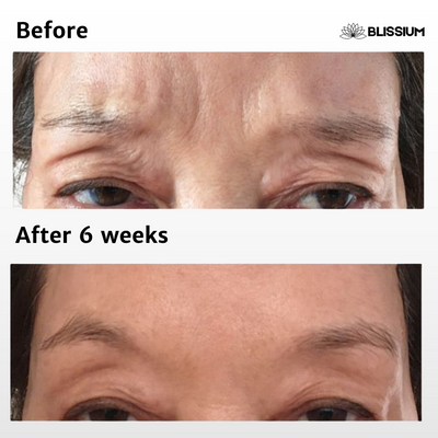 RevivEyes™ Micro-Infusion Patches