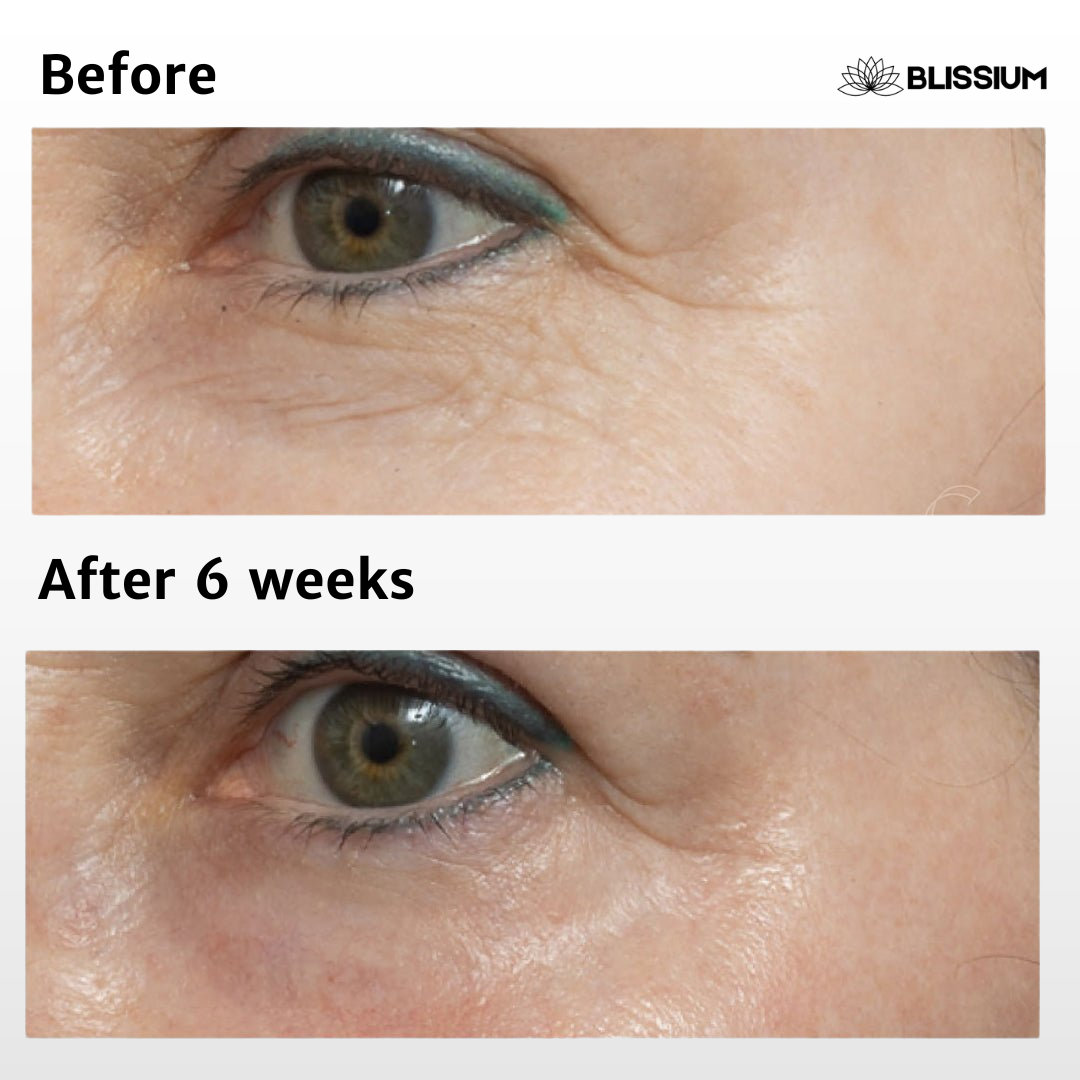 RevivEyes™ Micro-Infusion Patches