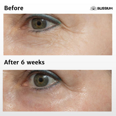 RevivEyes™ Micro-Infusion Patches